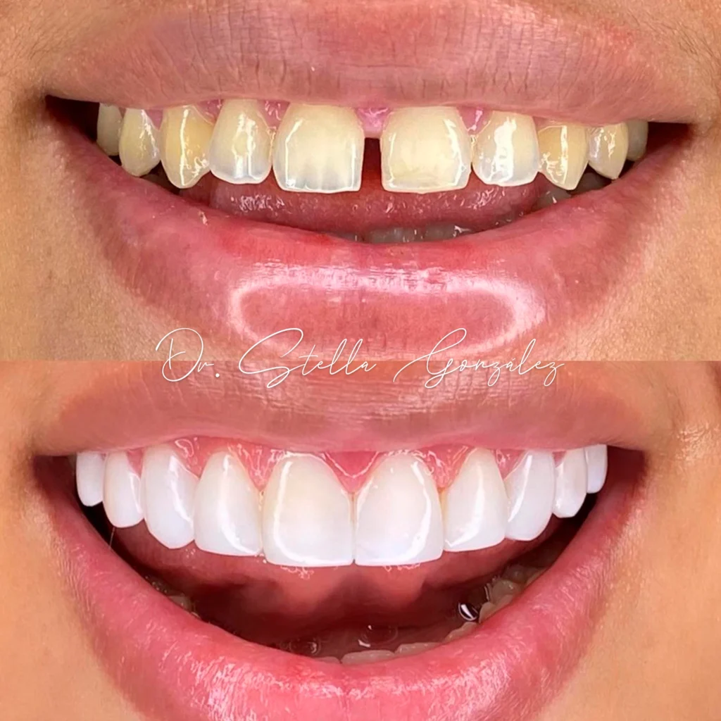 imagen de antes y despues de diseño de sonrisa