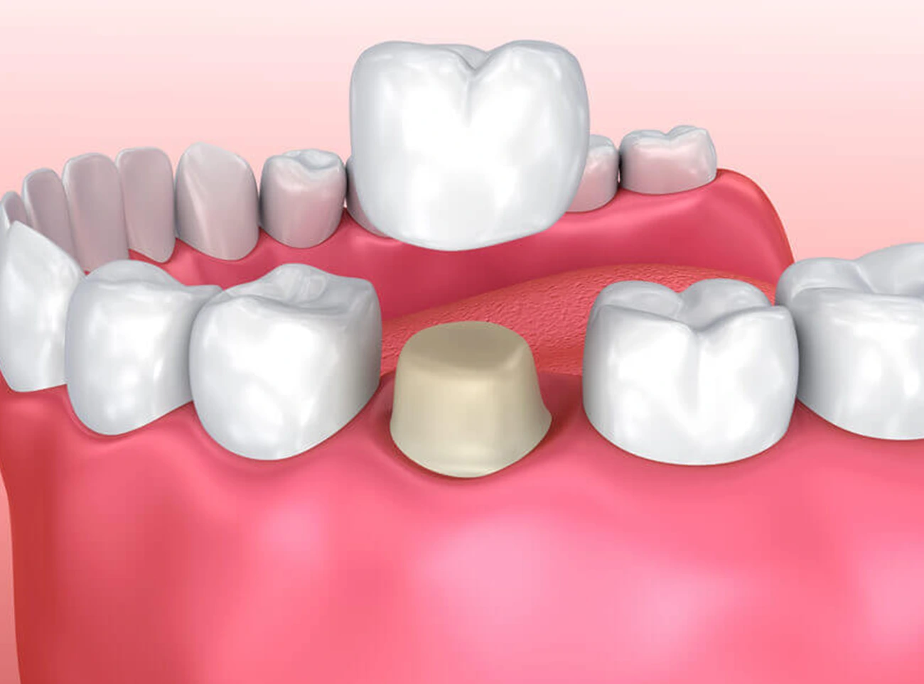 Corona dental, Tipos de coronas dentales