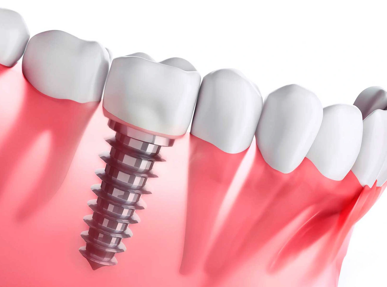 imagen de Odontologia de implantes