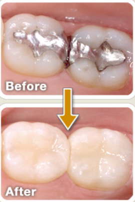 image of COMPOSITE RESTORATIONS