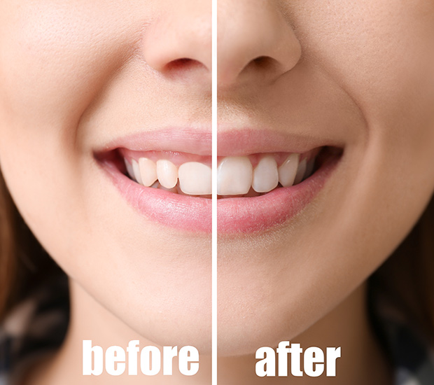 Smile design before and after