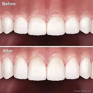 Before and After Teeth