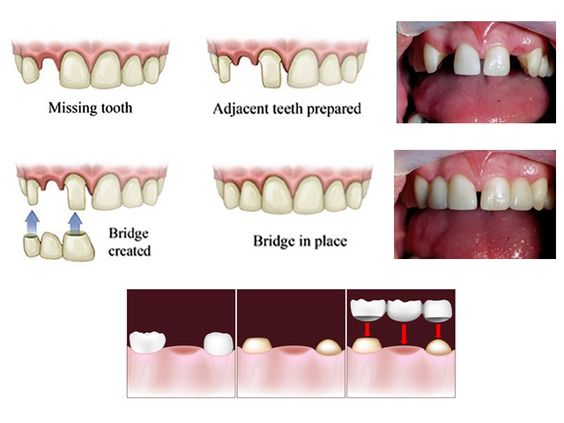 Dental Bridges