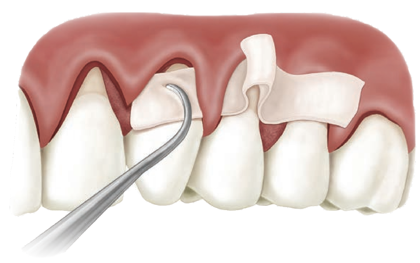 Gum Grafting Image