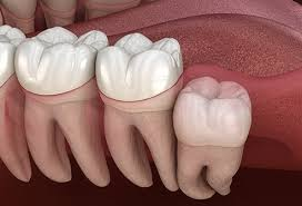 ORAL SURGERY IMAGE