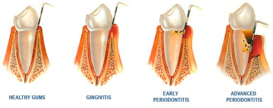 Periodontal Therapy Image