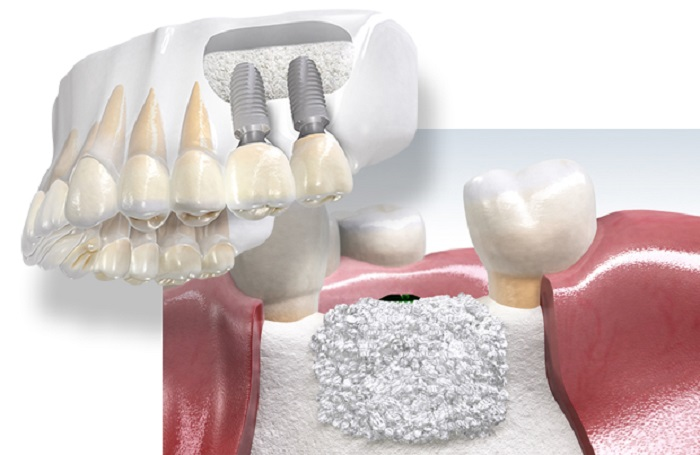 Bone Grafting